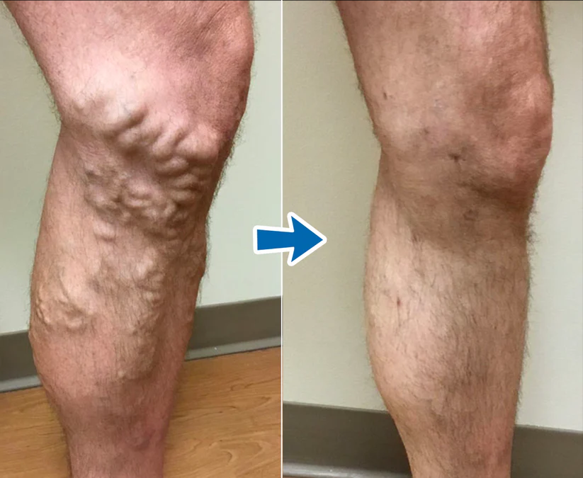 Cvreoz® VenoAid Varizen-Lösungsspray