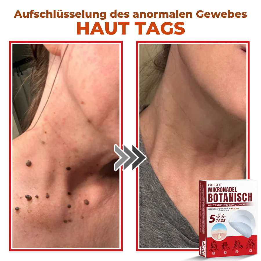 Fivfivgo® MikroNadel Botanisch Haut Tag Entfernung Patch 🇩🇪 Hergestellt in der Deutschland