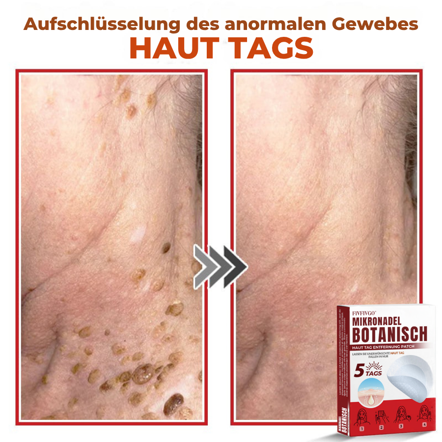 Fivfivgo® MikroNadel Botanisch Haut Tag Entfernung Patch 🇩🇪 Hergestellt in der Deutschland