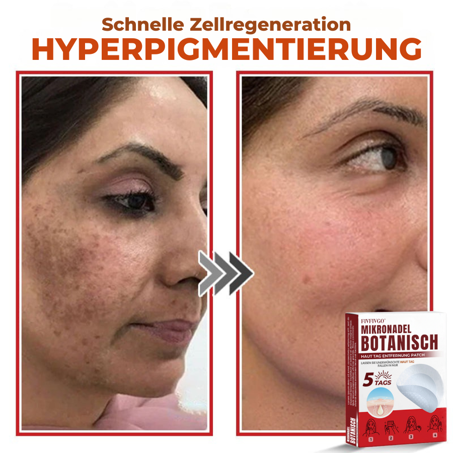 Fivfivgo® MikroNadel Botanisch Haut Tag Entfernung Patch 🇩🇪 Hergestellt in der Deutschland