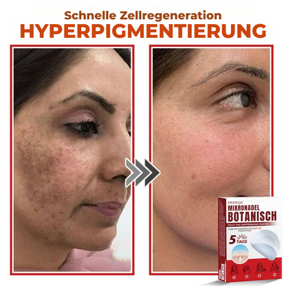 Fivfivgo® MikroNadel Botanisch Haut Tag Entfernung Patch 🇩🇪 Hergestellt in der Deutschland