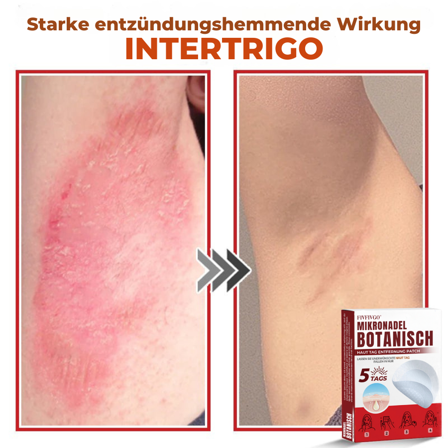 Fivfivgo® MikroNadel Botanisch Haut Tag Entfernung Patch 🇩🇪 Hergestellt in der Deutschland