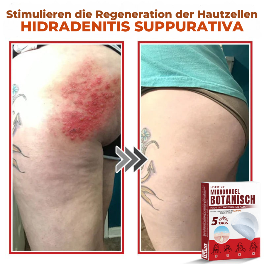 Fivfivgo® MikroNadel Botanisch Haut Tag Entfernung Patch 🇩🇪 Hergestellt in der Deutschland
