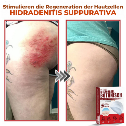 Fivfivgo® MikroNadel Botanisch Haut Tag Entfernung Patch 🇩🇪 Hergestellt in der Deutschland