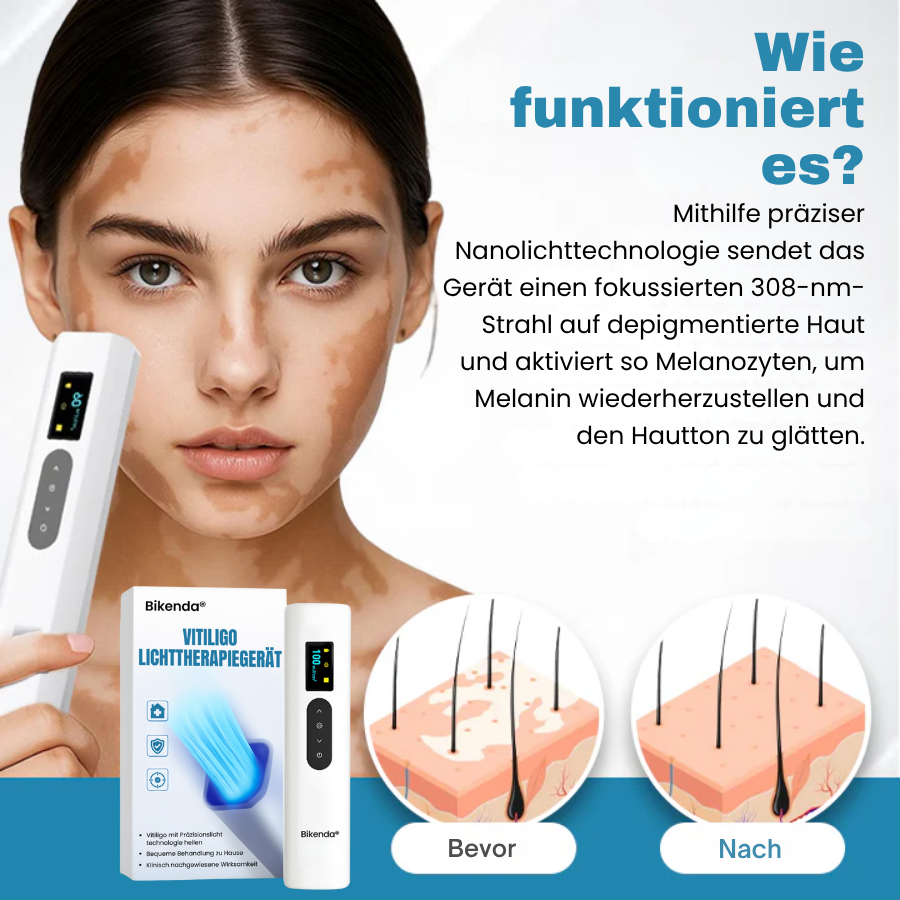 Bikenda® Vitiligo-Lichttherapiegerät