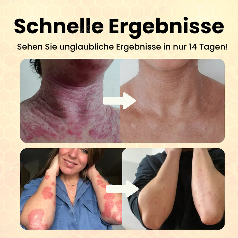 Fivfivgo® Bienengift Psoriasis Behandlung Creme