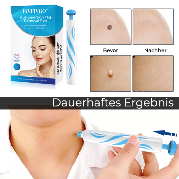 Fivfivgo™ Stift zur Entfernung von Hautmarkierungen zu Hause