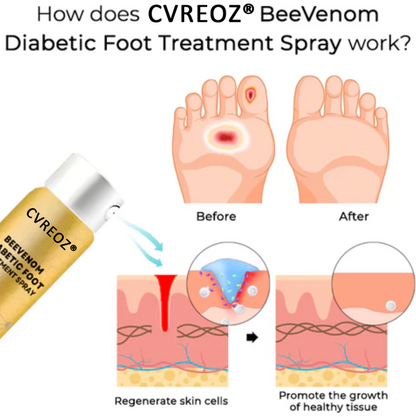 Cvreoz® BeeVenom Diabetiker-Fußpflege-Spray
