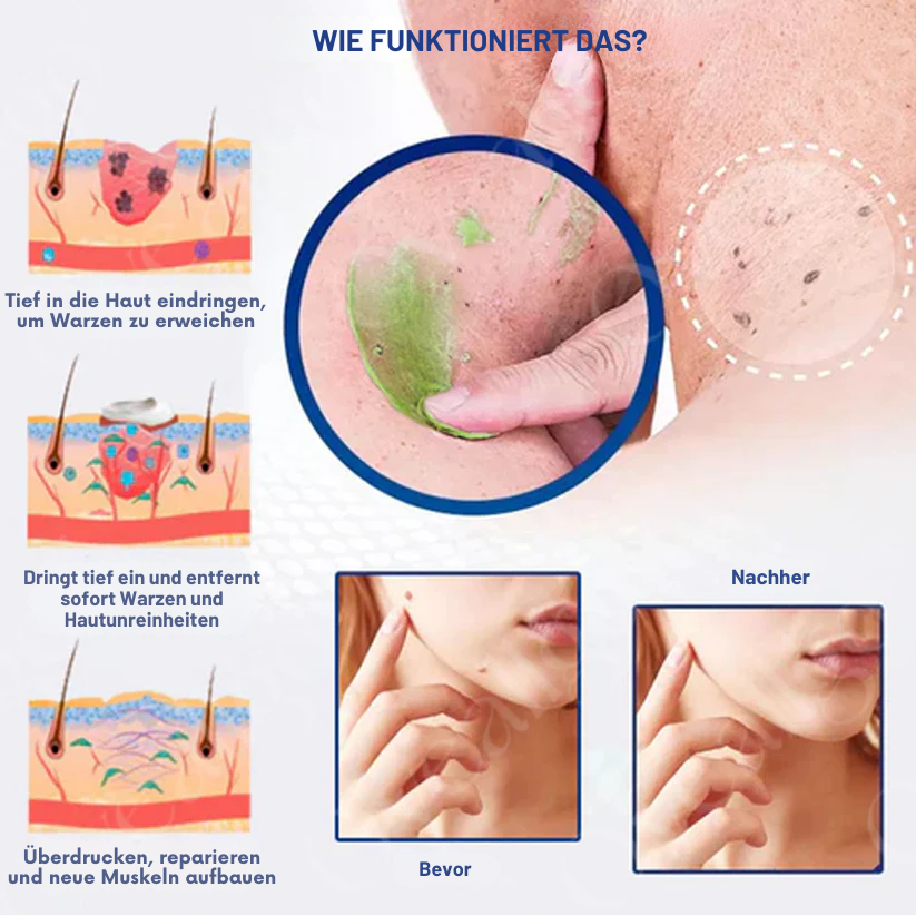 ✅ Offizieller Laden: Fivfivgo® NatureErase Sofortiges Gel zur Entfernung von Muttermalen und Flecken