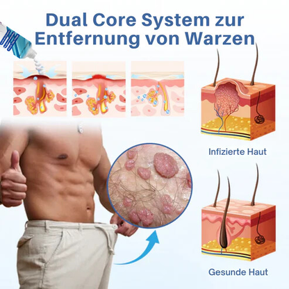 Oveallgo® GentX Warzenentlastungs Creme