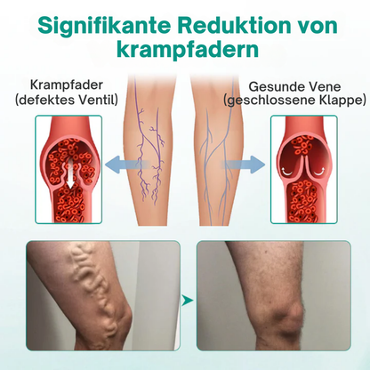 Cvreoz® LegRenew Krampfadern-Patch