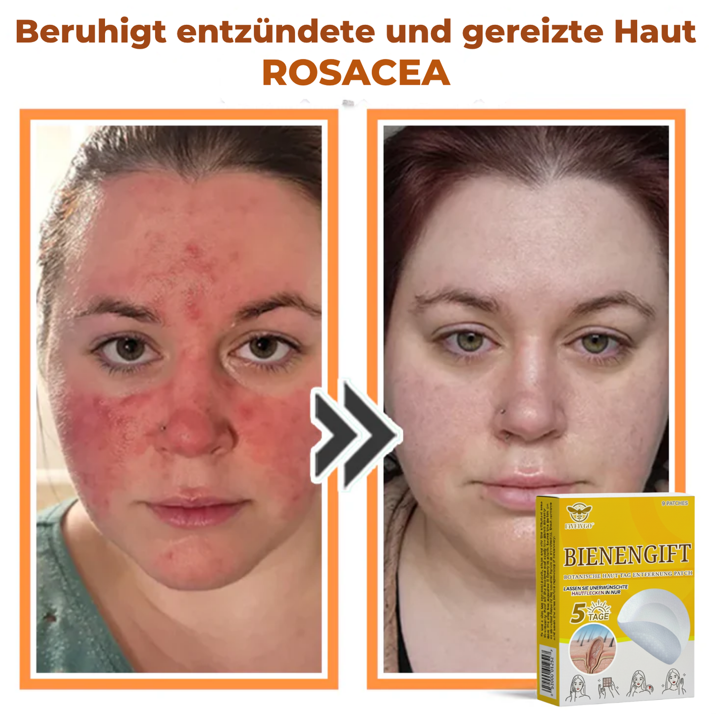 Fivfivgo® Bienengift Botanische Haut Tag Entfernung Patch 🇩🇪 Hergestellt in den Germany