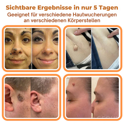 Fivfivgo® Bienengift Botanische Haut Tag Entfernung Patch 🇩🇪 Hergestellt in den Germany