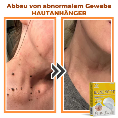 Fivfivgo® Bienengift Botanische Haut Tag Entfernung Patch 🇩🇪 Hergestellt in den Germany