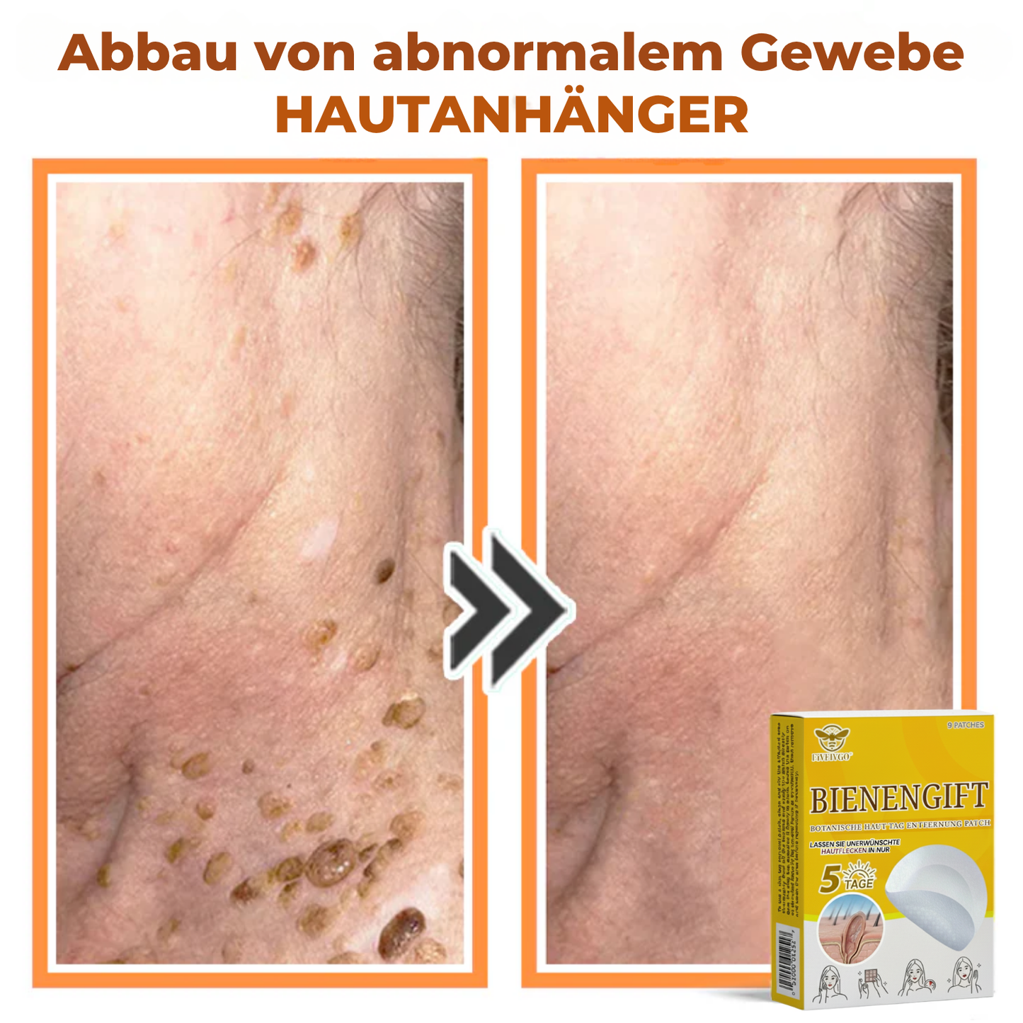 Fivfivgo® Bienengift Botanische Haut Tag Entfernung Patch 🇩🇪 Hergestellt in den Germany