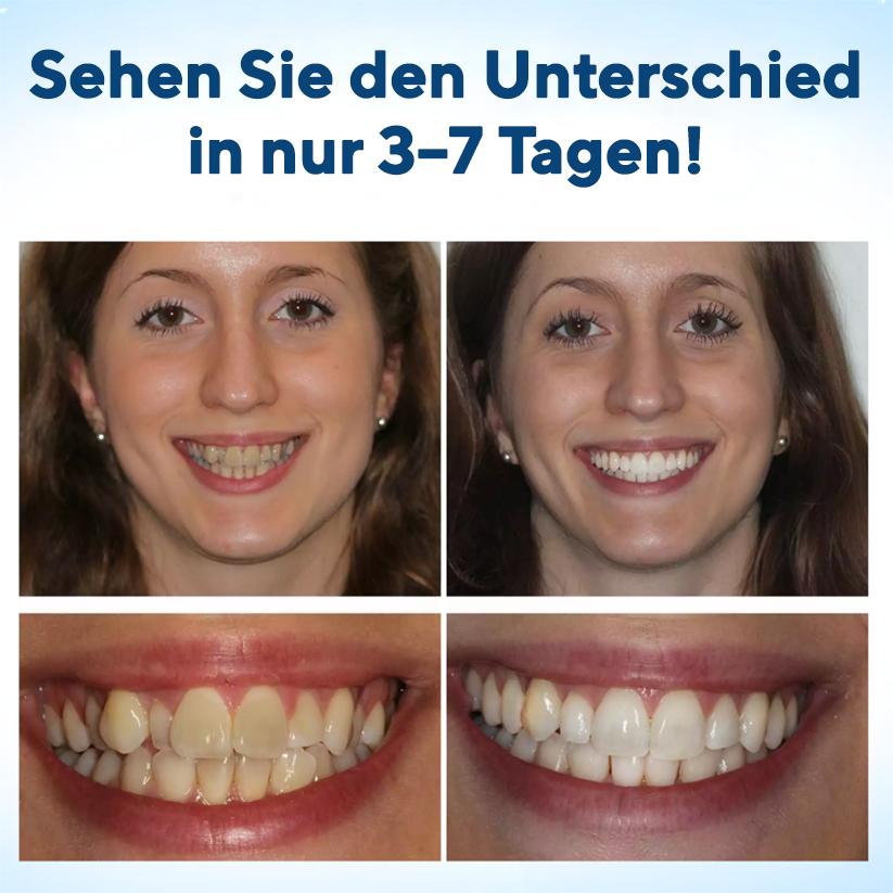 Fivfivgo® WhitenEase Pro Zahnaufhellungsstift
