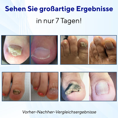 Fivfivgo® MycoShield Pro Nagelpilzpflaster 🏥 Sichtbare Ergebnisse in 2 Tagen + Reparatur in Profiqualität