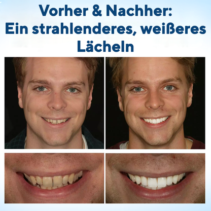 Fivfivgo® WhitenEase Pro Zahnaufhellungsstift