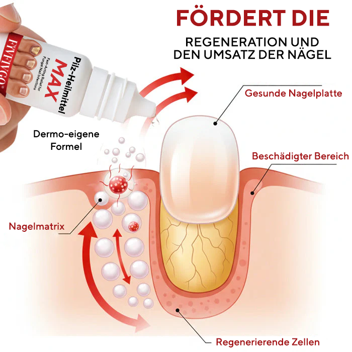 Fivfivgo® Pilz-Heilmittel Max – Schnell wirkende Linderung bei Nagelpilzinfektionen