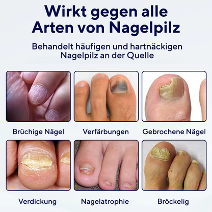 Fivfivgo® Antimykotisches Nagelreparaturpflaster