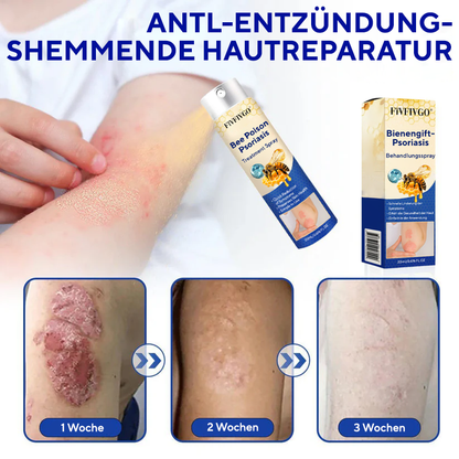Fivfivgo® Bienengift-Psoriasis-Behandlungsspray