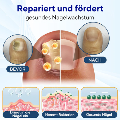 Fivfivgo® MycoShield Pro Nagelpilzpflaster 🏥 Sichtbare Ergebnisse in 2 Tagen + Reparatur in Profiqualität