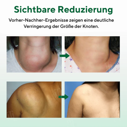 Cvreoz® Knot-X Lipom-Auflösungscreme