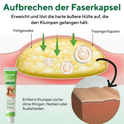 Cvreoz® Knot-X Lipom-Auflösungscreme