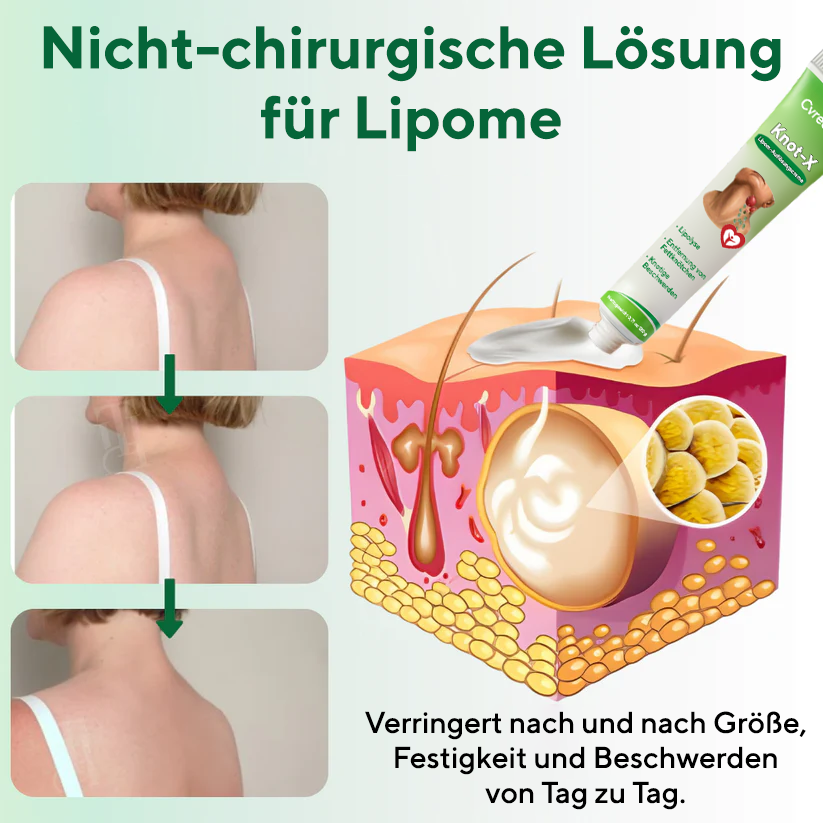 Cvreoz® Knot-X Lipom-Auflösungscreme