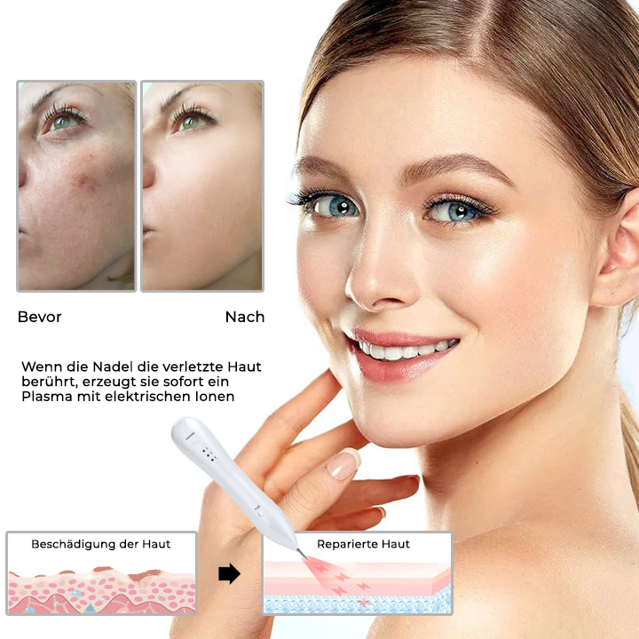 Fivfivgo® Fortschrittlicher Plasma-Laser-Punktreinigungsstift