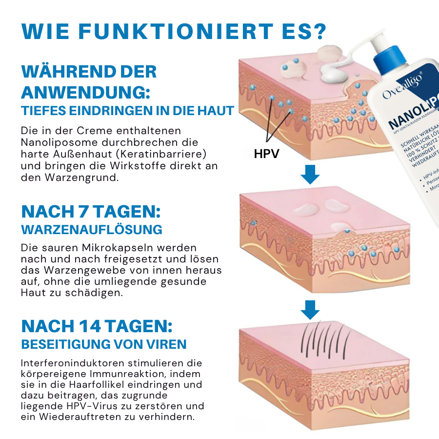 Oveallgo® NanoLipo HPV Genital Warzen Radiergummi Creme