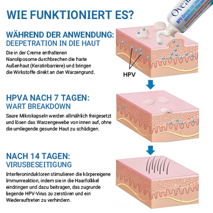 Oveallgo® HPV-Creme zur Linderung genitaler Warzen