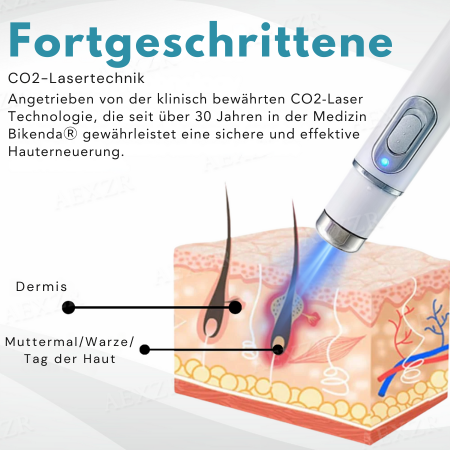 Bikenda® PRO Nicht-invasiv Leberfleck- und Warzenentfernungs-Laserstift