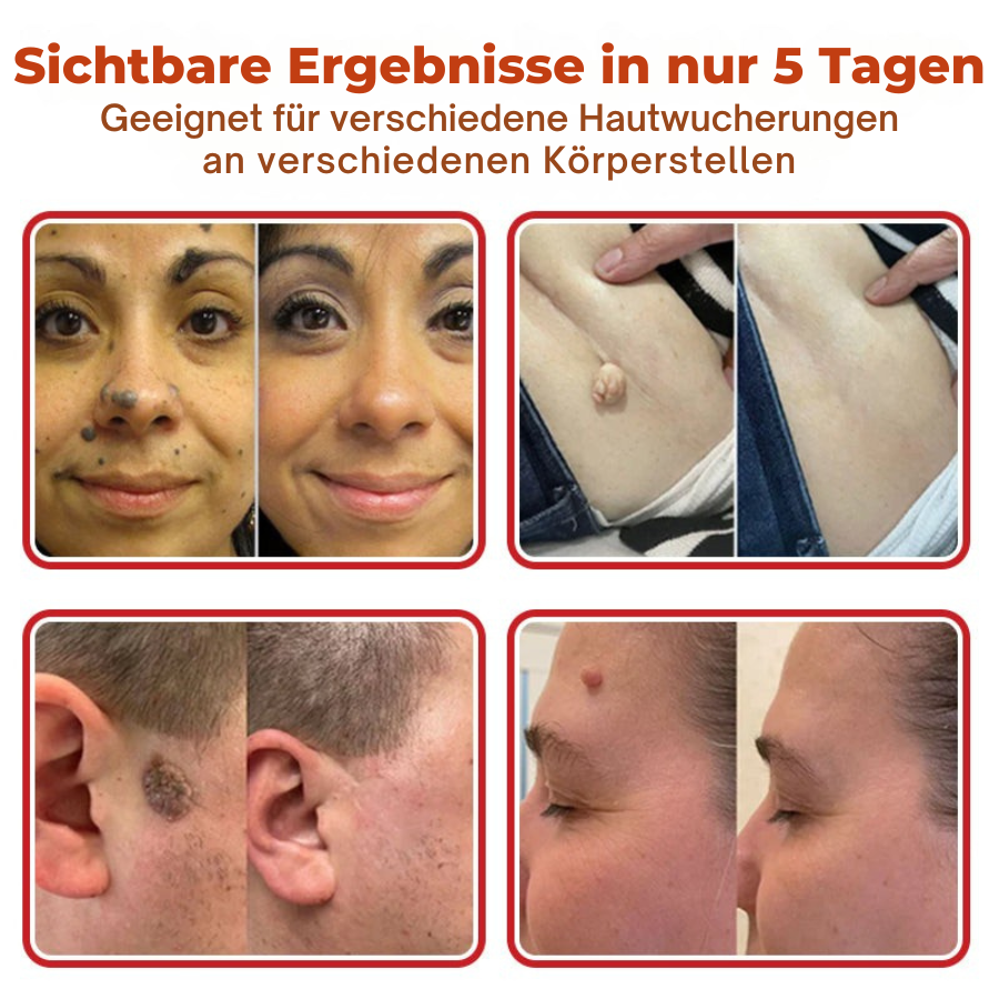 Fivfivgo® MikroNadel Botanisch Haut Tag Entfernung Patch 🇩🇪 Hergestellt in der Deutschland
